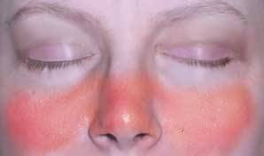إصابات  الذئبة الحمراء الجهازية الحادة acute lupus erythematosus