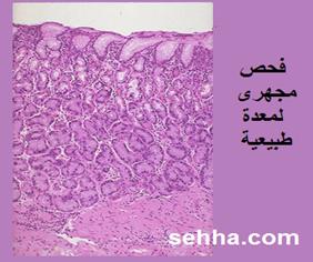  Gastric-cancer13.jpg