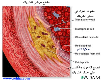 arterioscl2.gif