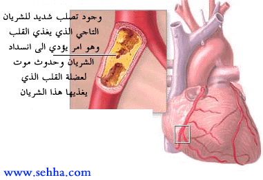 arterioscl3.gif