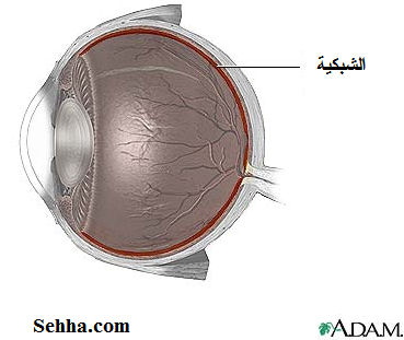   Retinal detachment