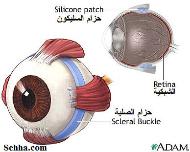   Retinal detachment