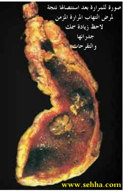 gallbladder8.gif