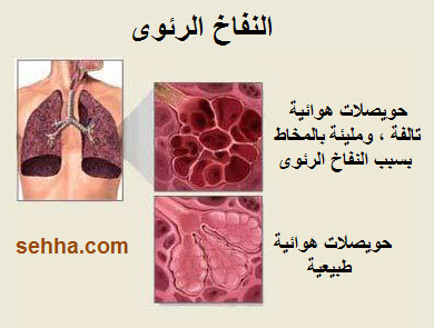   Emphysema Lung