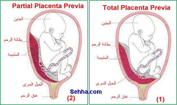 1)  -    Cesarean Section  