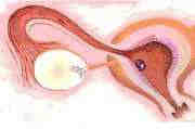    Ectopic gestation