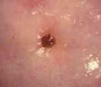    Cervical Ulcers 
