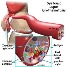الذئبة الحمراء الجهازية Systemic Lupus Erythematosus