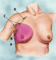 علاج سرطان الثدي - ‏الجراحة Surgery