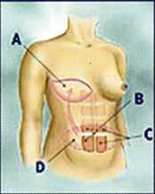 علاج سرطان الثدي - ‏الجراحة Surgery