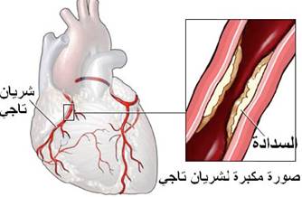 موت عضلة القلب (احتشاء عضلة القلب),الأعراض,العلاج,الوقا ية Myocardial infarction