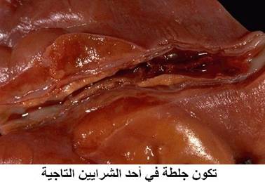 موت عضلة القلب (احتشاء عضلة القلب),الأعراض,العلاج,الوقا ية Myocardial infarction