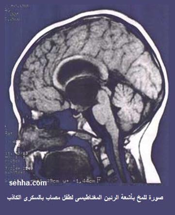 أشعة الرنين المغناطيسي على المخ و الغدة النخامية