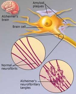وجود رقع أو لويحات حول خلايا المخ ، وتشابكات أو كتل داخل خلايا المخ 