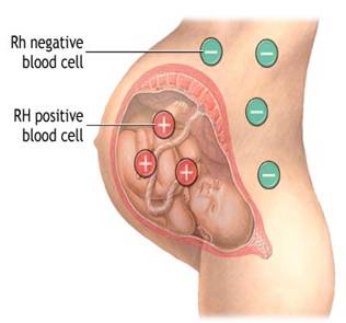 العامل الريسي Rhesus factor وأثره على الحمل والأجنة والمواليد
