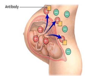 العامل الريسي Rhesus factor وأثره على الحمل والأجنة والمواليد